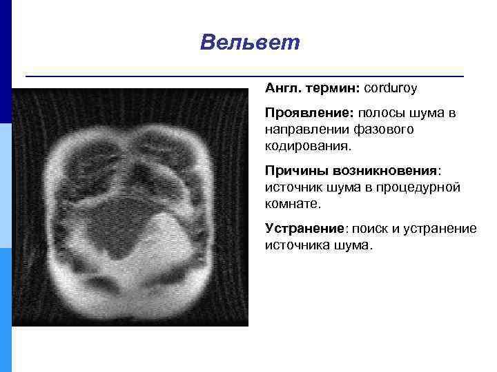 Вельвет Англ. термин: corduroy Проявление: полосы шума в направлении фазового кодирования. Причины возникновения: источник