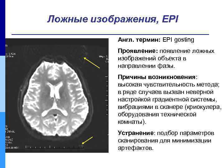 Ложные изображения, EPI Англ. термин: EPI gosting Проявление: появление ложных изображений объекта в направлении