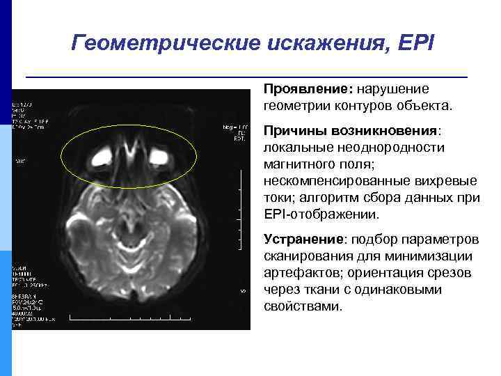 Геометрические искажения, EPI Проявление: нарушение геометрии контуров объекта. Причины возникновения: локальные неоднородности магнитного поля;