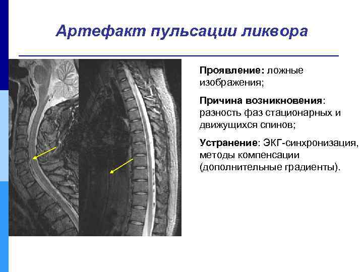 Артефакт пульсации ликвора Проявление: ложные изображения; Причина возникновения: разность фаз стационарных и движущихся спинов;