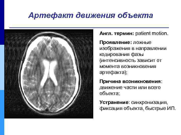 Артефакт движения объекта Англ. термин: patient motion. Проявление: ложные изображения в направлении кодирования фазы