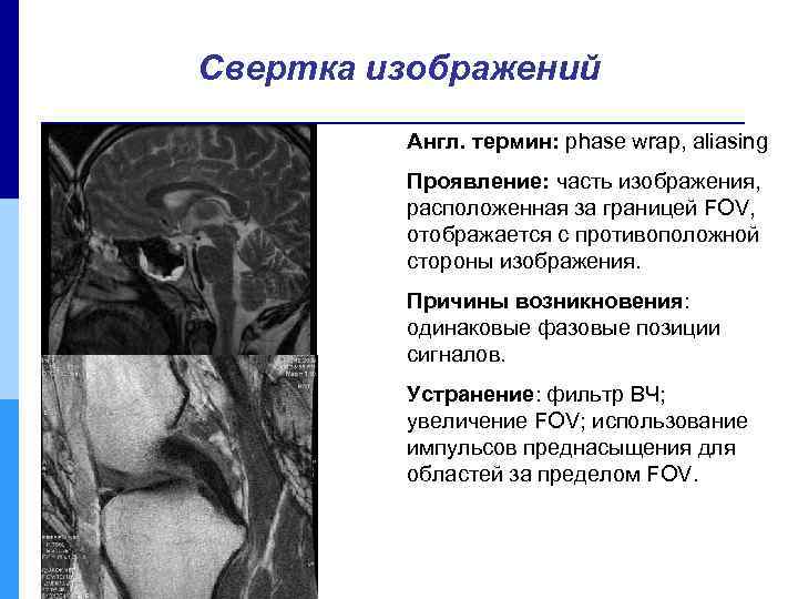 Свертка изображений Англ. термин: phase wrap, aliasing Проявление: часть изображения, расположенная за границей FOV,