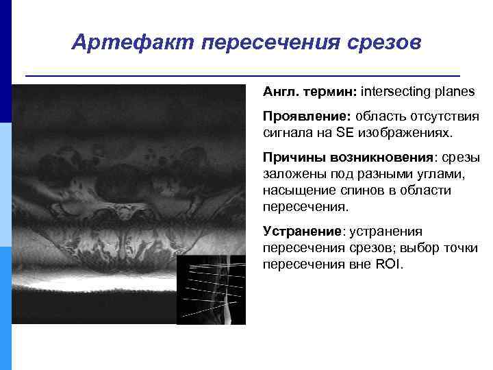 Артефакт пересечения срезов Англ. термин: intersecting planes Проявление: область отсутствия сигнала на SE изображениях.