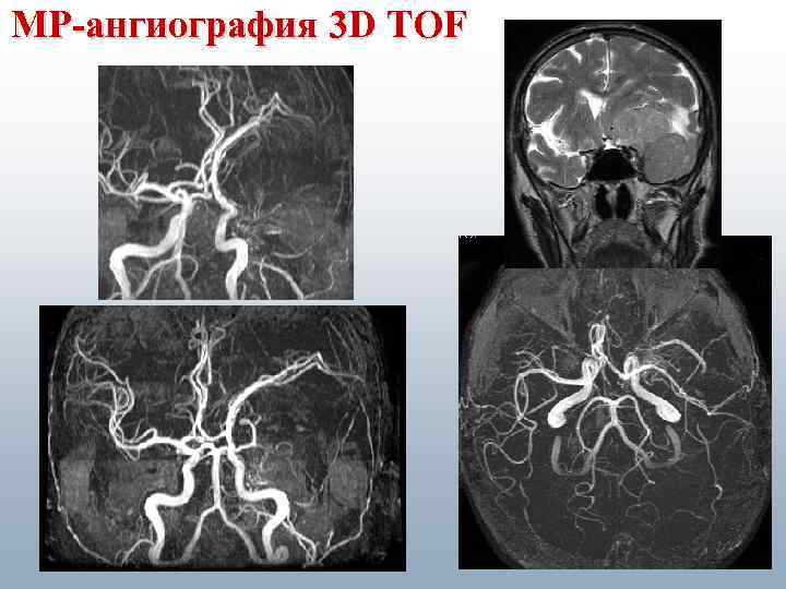 МР-ангиография 3 D TOF 