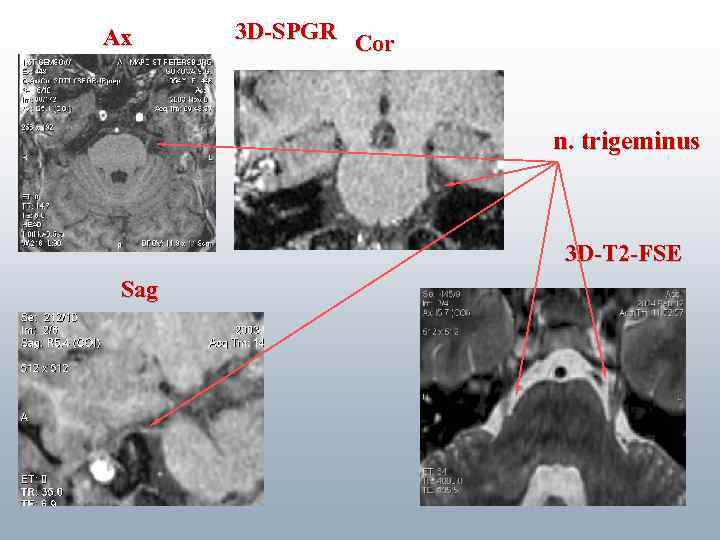 Ax 3 D-SPGR Cor n. trigeminus 3 D-Т 2 -FSE Sag 