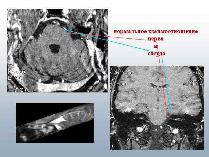 нормальное взаимоотношение нерва и сосуда 