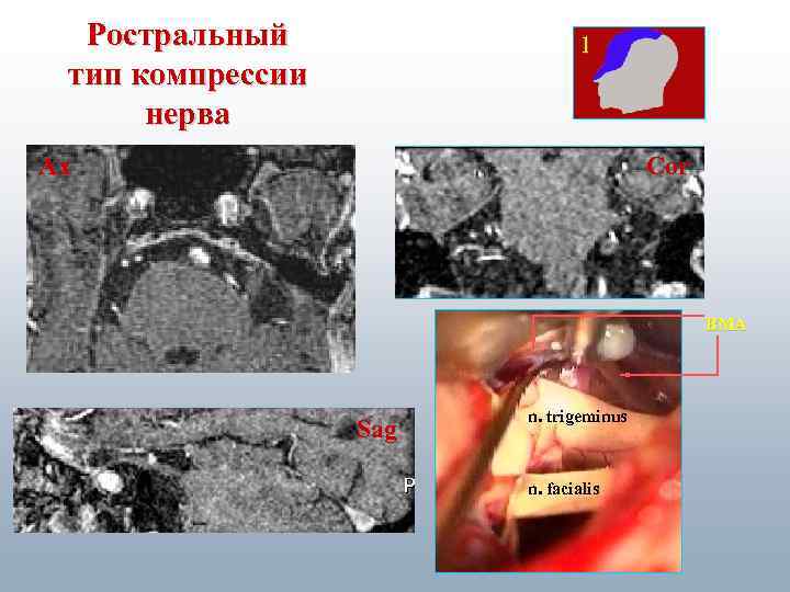 Ростральный тип компрессии нерва 1 Ax Cor ВМА Sag n. trigeminus n. facialis 