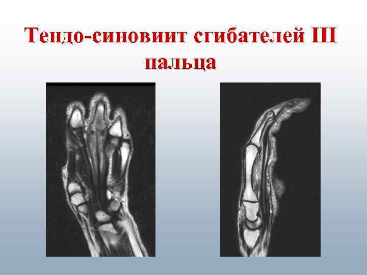 Тендо-синовиит сгибателей III пальца 