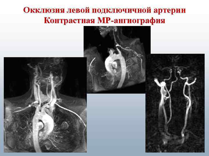Окклюзия левой подключичной артерии Контрастная МР-ангиография 