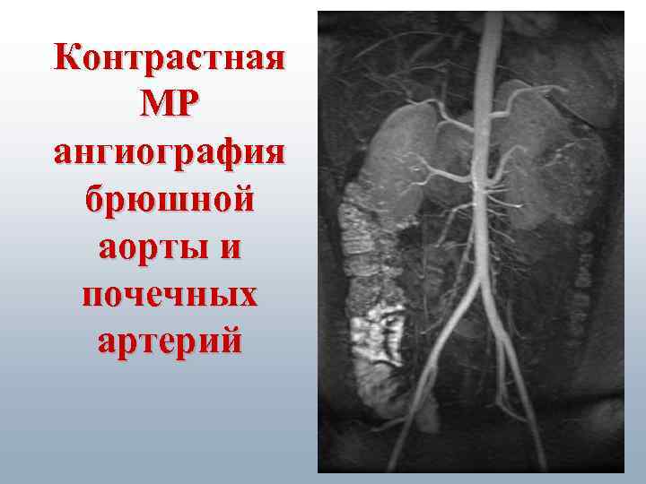 Контрастная МР ангиография брюшной аорты и почечных артерий 