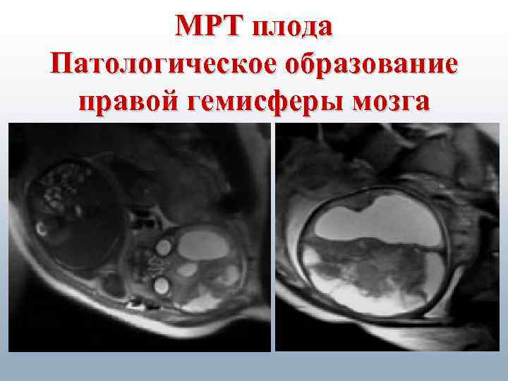 МРТ плода Патологическое образование правой гемисферы мозга 