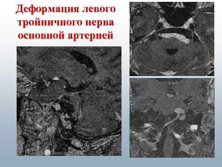 Деформация левого тройничного нерва основной артерией 