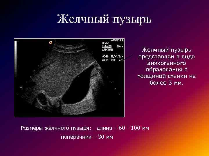 Желчный пузырь представлен в виде анэхогенного образования с толщиной стенки не более 3 мм.