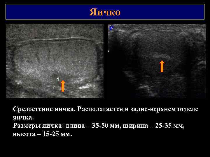 Яичко Средостение яичка. Располагается в задне верхнем отделе яичка. Размеры яичка: длина – 35