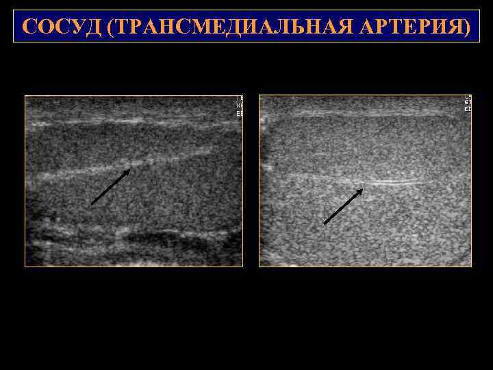 СОСУД (ТРАНСМЕДИАЛЬНАЯ АРТЕРИЯ) 