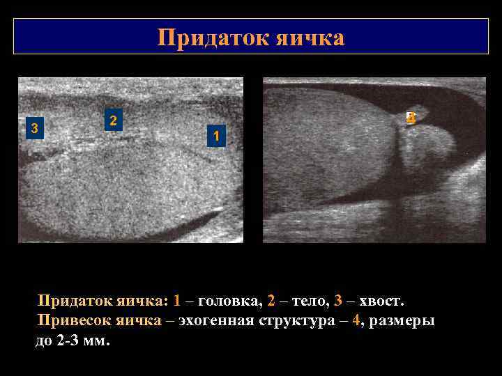 Придаток яичка 3 4 2 1 Придаток яичка: 1 – головка, 2 – тело,