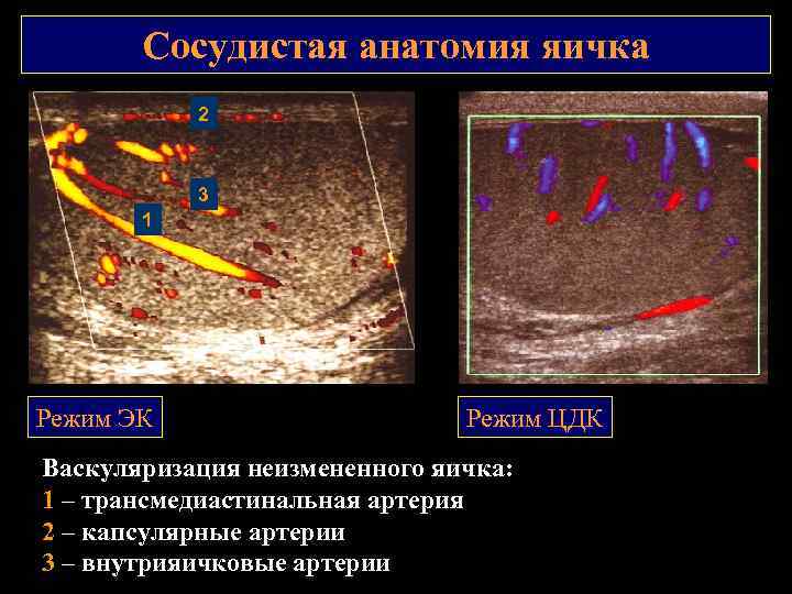 Сосудистая анатомия яичка 2 3 1 Режим ЭК Режим ЦДК Васкуляризация неизмененного яичка: 1