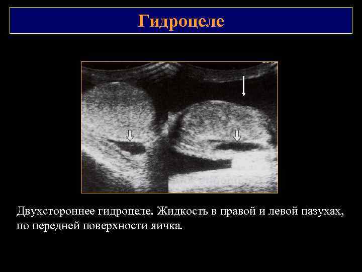 Гидроцеле Двухстороннее гидроцеле. Жидкость в правой и левой пазухах, по передней поверхности яичка. 