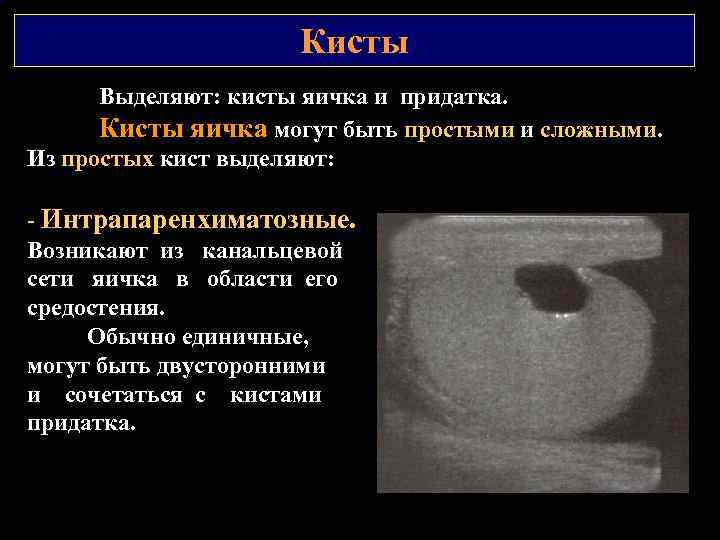 Кисты Выделяют: кисты яичка и придатка. Кисты яичка могут быть простыми и сложными. Из