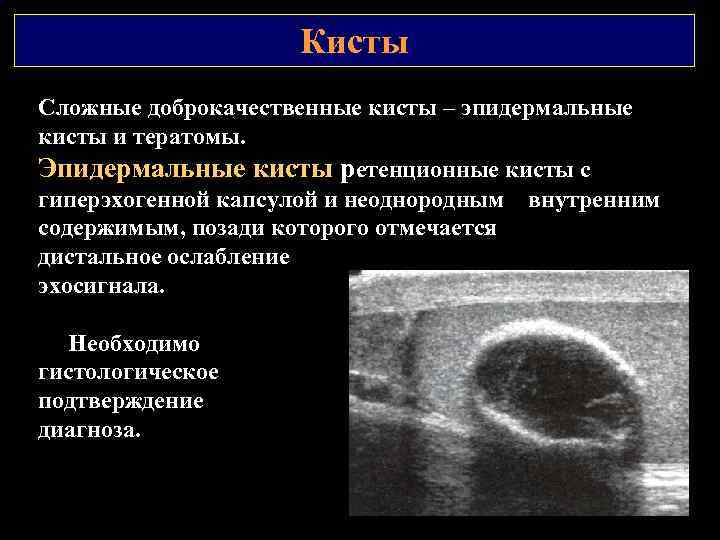 Кисты Сложные доброкачественные кисты – эпидермальные кисты и тератомы. Эпидермальные кисты ретенционные кисты с