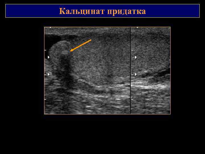 Кальцинаты в простате что это такое. Кальцинаты в простате на УЗИ. Ультразвуковая диагностика органов мошонки. Кальцинат в оболочке яичка на УЗИ.