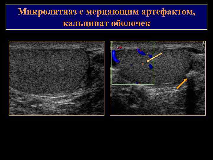 Микролитиаз с мерцающим артефактом, кальцинат оболочек 