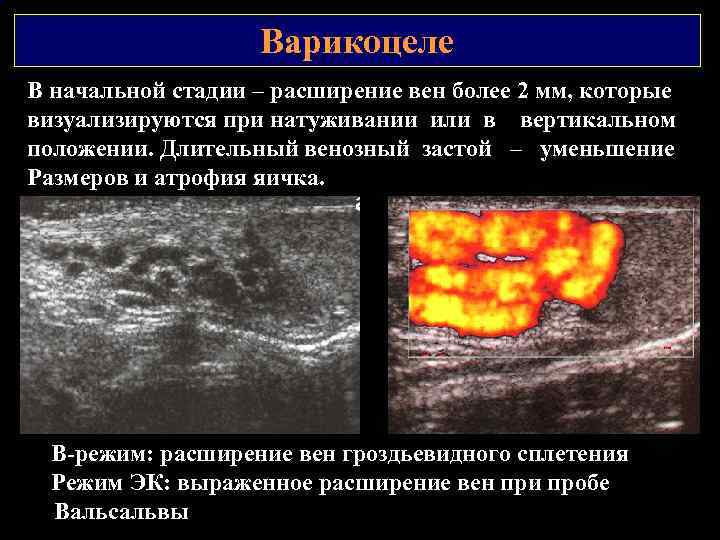 Варикоцеле 3 стадия