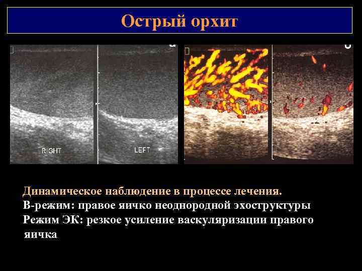 Острый орхит Динамическое наблюдение в процессе лечения. В режим: правое яичко неоднородной эхоструктуры Режим