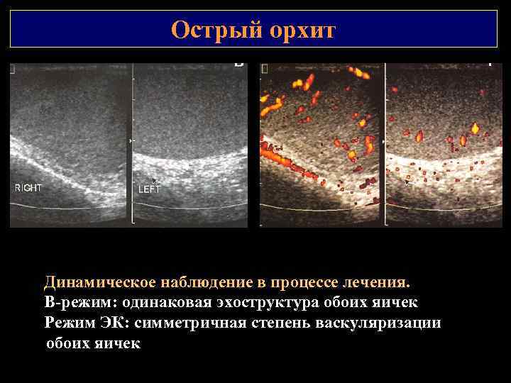 Острый орхит Динамическое наблюдение в процессе лечения. В режим: одинаковая эхоструктура обоих яичек Режим