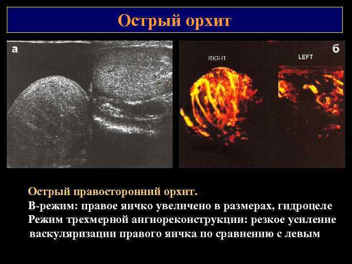 Острый орхит Острый правосторонний орхит. В режим: правое яичко увеличено в размерах, гидроцеле Режим