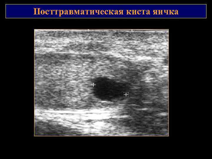 Посттравматическая киста яичка 