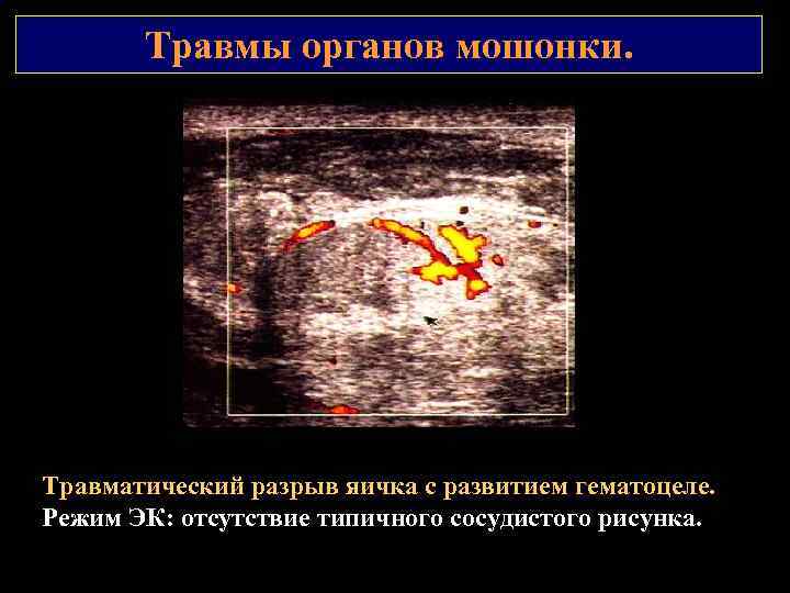 Травмы органов мошонки. Травматический разрыв яичка с развитием гематоцеле. Режим ЭК: отсутствие типичного сосудистого