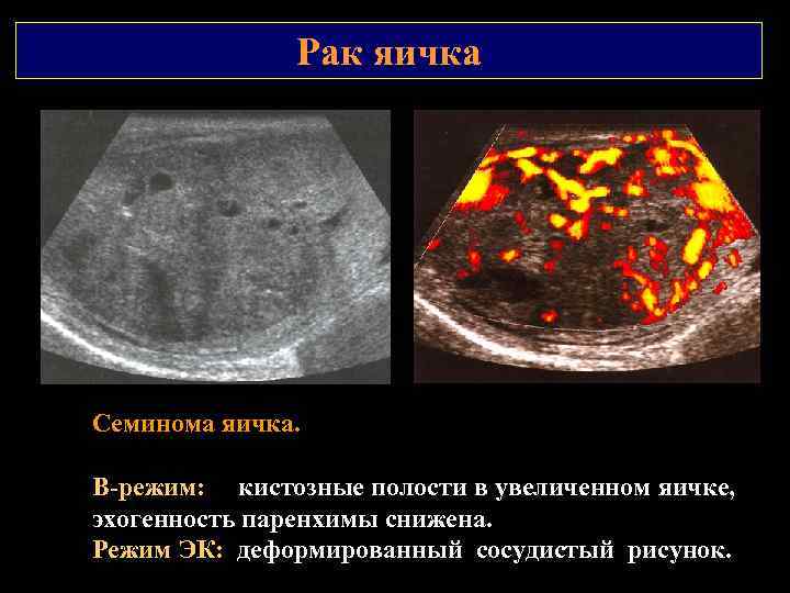 Рак яичка Семинома яичка. В режим: кистозные полости в увеличенном яичке, эхогенность паренхимы снижена.