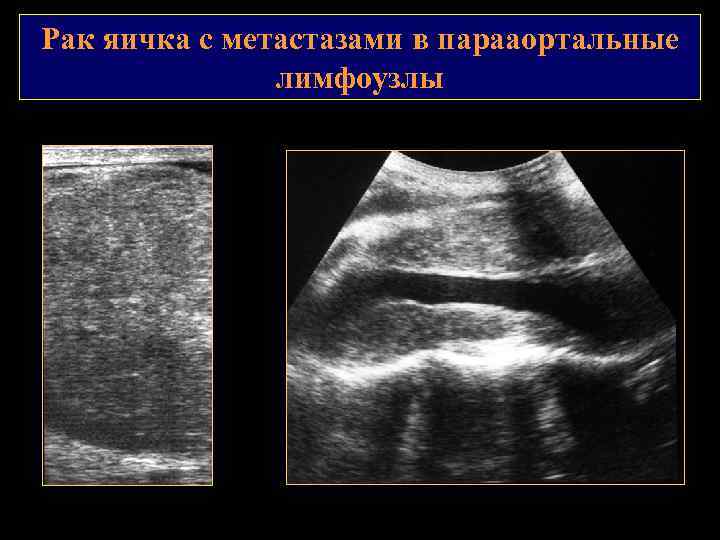 Рак яичка с метастазами в парааортальные лимфоузлы 