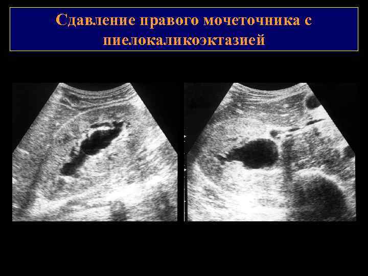 Сдавление правого мочеточника с пиелокаликоэктазией 