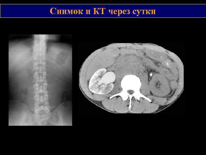 Снимок и КТ через сутки 