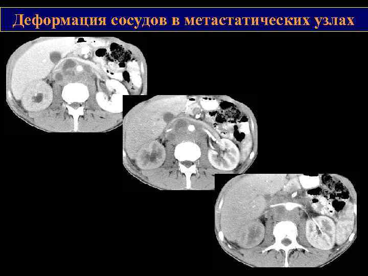 Деформация сосудов в метастатических узлах 