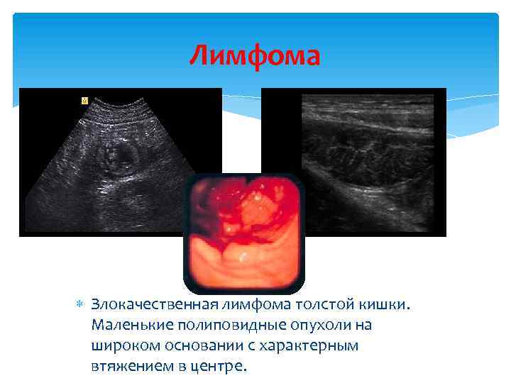 Лимфома Злокачественная лимфома толстой кишки. Маленькие полиповидные опухоли на широком основании с характерным втяжением