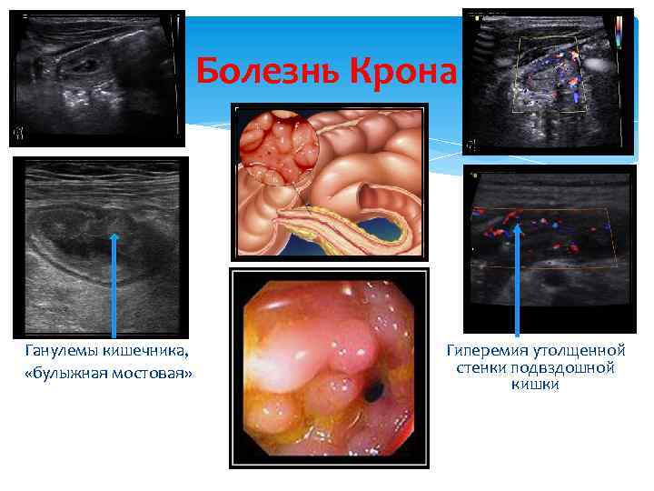 Болезнь Крона Ганулемы кишечника, «булыжная мостовая» Гиперемия утолщенной стенки подвздошной кишки 