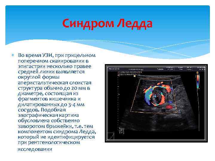 Синдром Ледда Во время УЗИ, прицельном поперечном сканировании в эпигастрии несколько правее средней линии