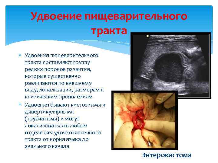 Удвоение пищеварительного тракта Удвоения пищеварительного тракта составляют группу редких пороков развития, которые существенно различаются