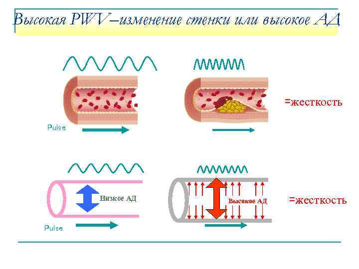 Высокая PWV–изменение стенки или высокое АД =жесткость Pulse Низкое АД Pulse Высокое АД =жесткость