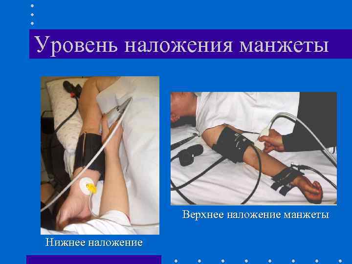 Уровень наложения манжеты Верхнее наложение манжеты Нижнее наложение 