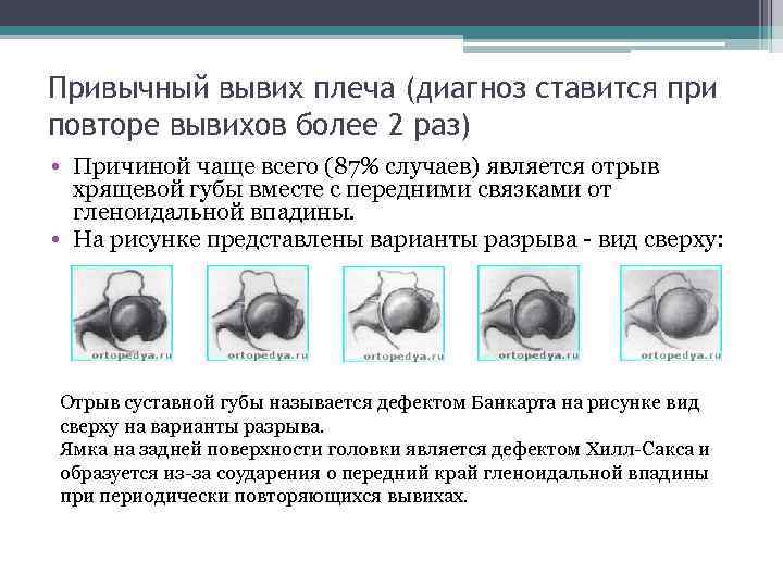 Привычный вывих плеча (диагноз ставится при повторе вывихов более 2 раз) • Причиной чаще