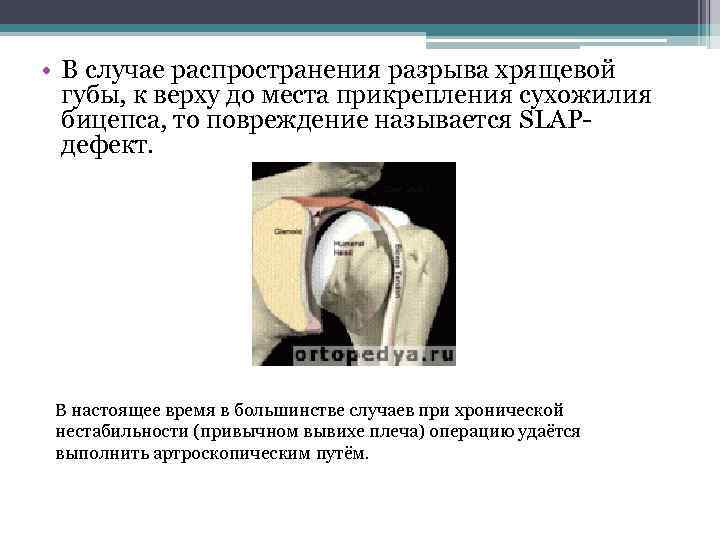  • В случае распространения разрыва хрящевой губы, к верху до места прикрепления сухожилия