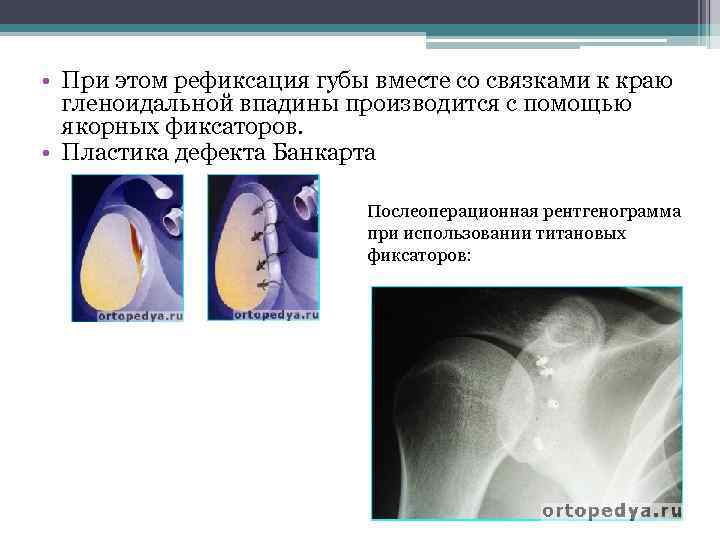  • При этом рефиксация губы вместе со связками к краю гленоидальной впадины производится