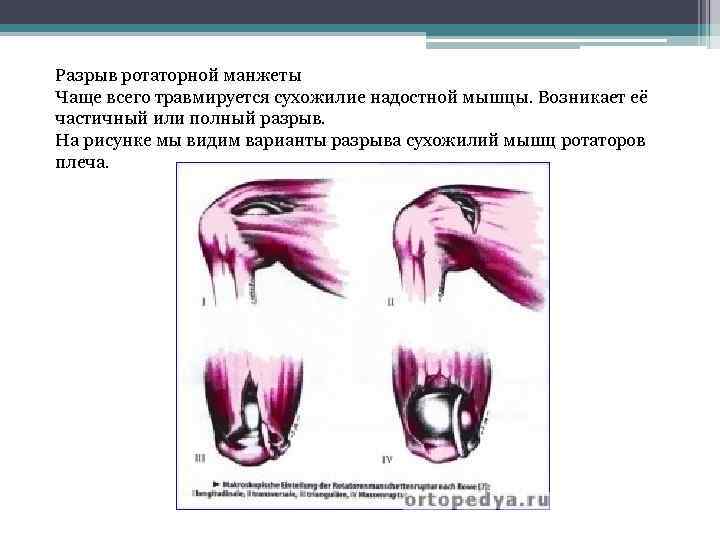 Разрыв ротаторной манжеты Чаще всего травмируется сухожилие надостной мышцы. Возникает её частичный или полный