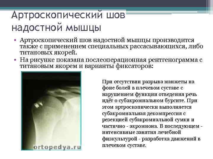 Артроскопический шов надостной мышцы • Артроскопический шов надостной мышцы производится также с применением специальных