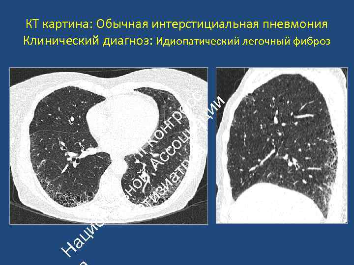 Н ац ио н ьн Ф ой II ти А К зи с он