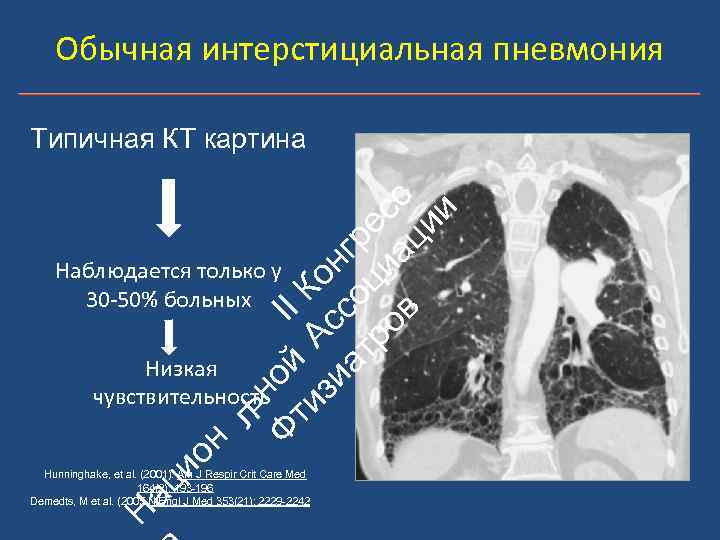 Обычная интерстициальная пневмония ьн Ф ой II ти А К зи с он ат